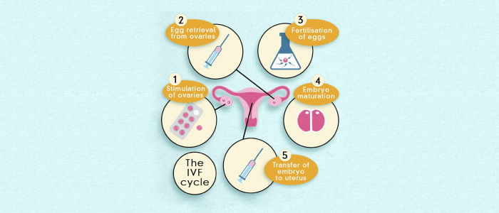 How does IVF Work – An Overview